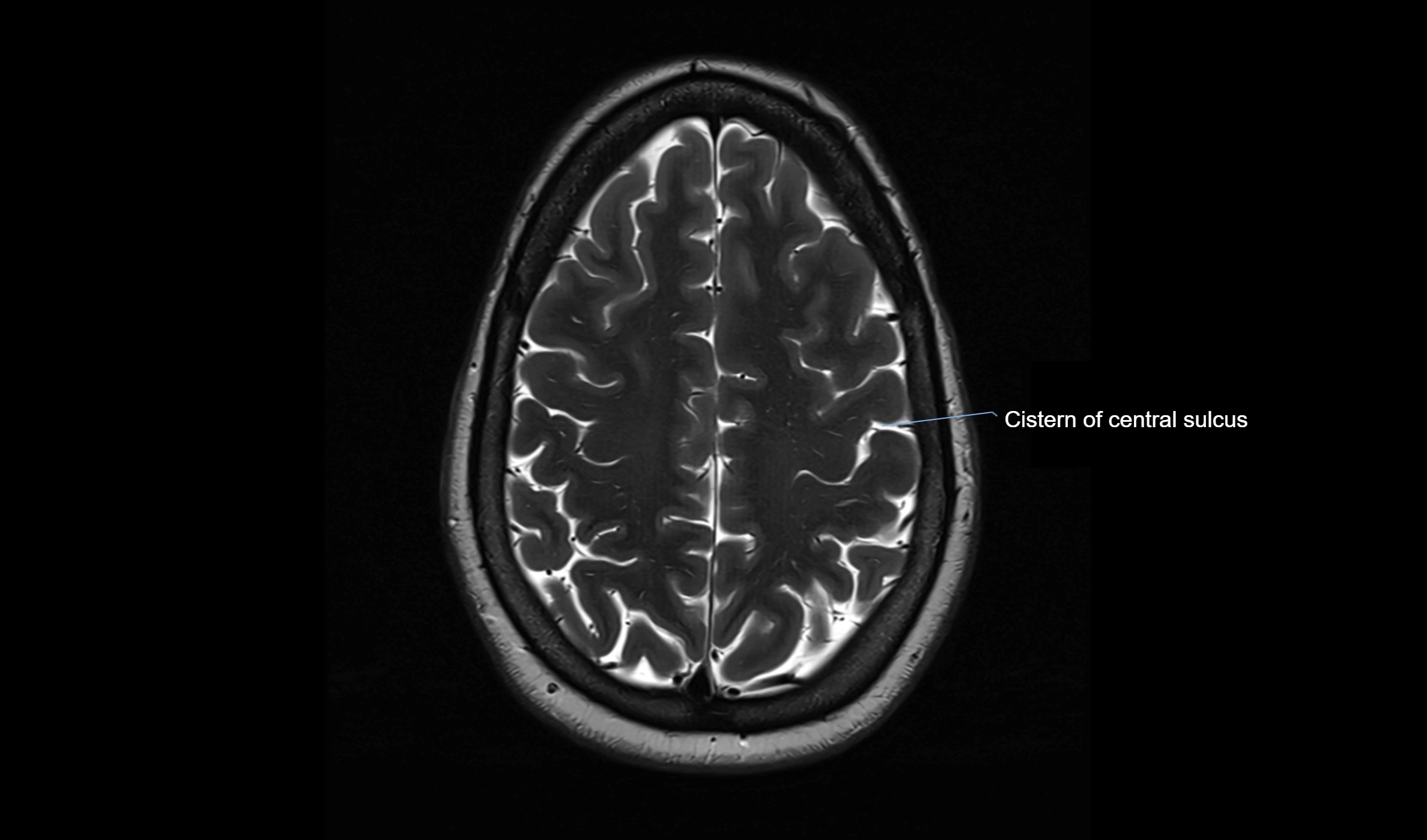 Brain cisterns  and ventricles  axial anatomy 3T MRI image-img-00001-00045.webp